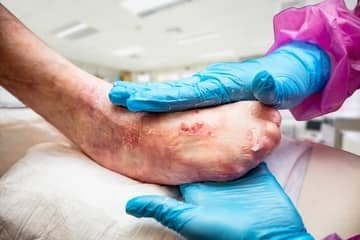 Choroba motýlích krídel (Epidermolysis bullosa): Čo to je a aká je liečba?