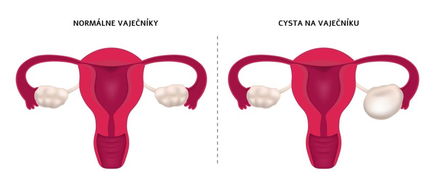 Normálne vaječníky vs cysta na vaječníku