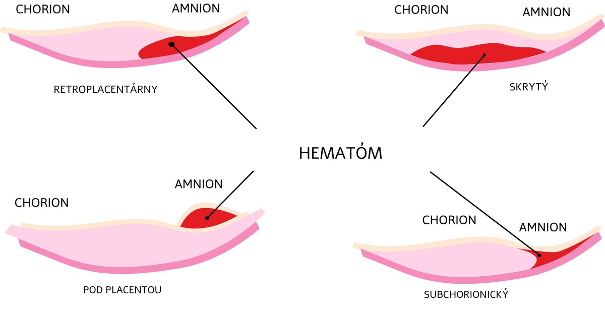 Hematóm v tehotenstve