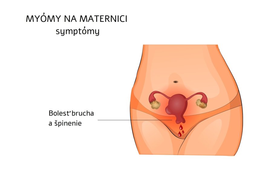 Myóm na maternici symptómy