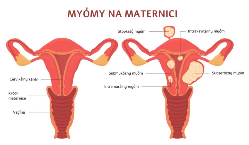 Druhy myómu na maternici