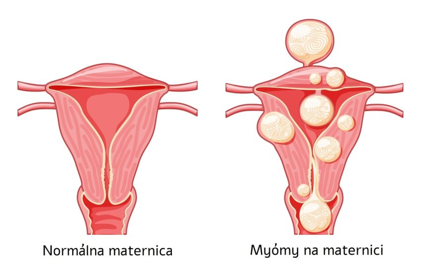 Normálna maternica vs myómy