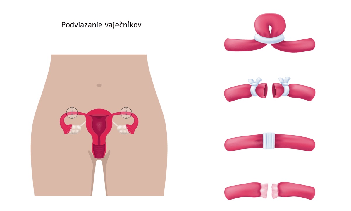Metódy podviazania vaječníkov