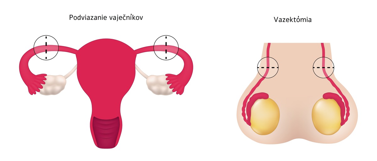 Podviazanie vaječníkov vs vazektómia