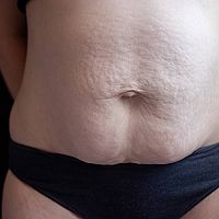 Diastasis Recti